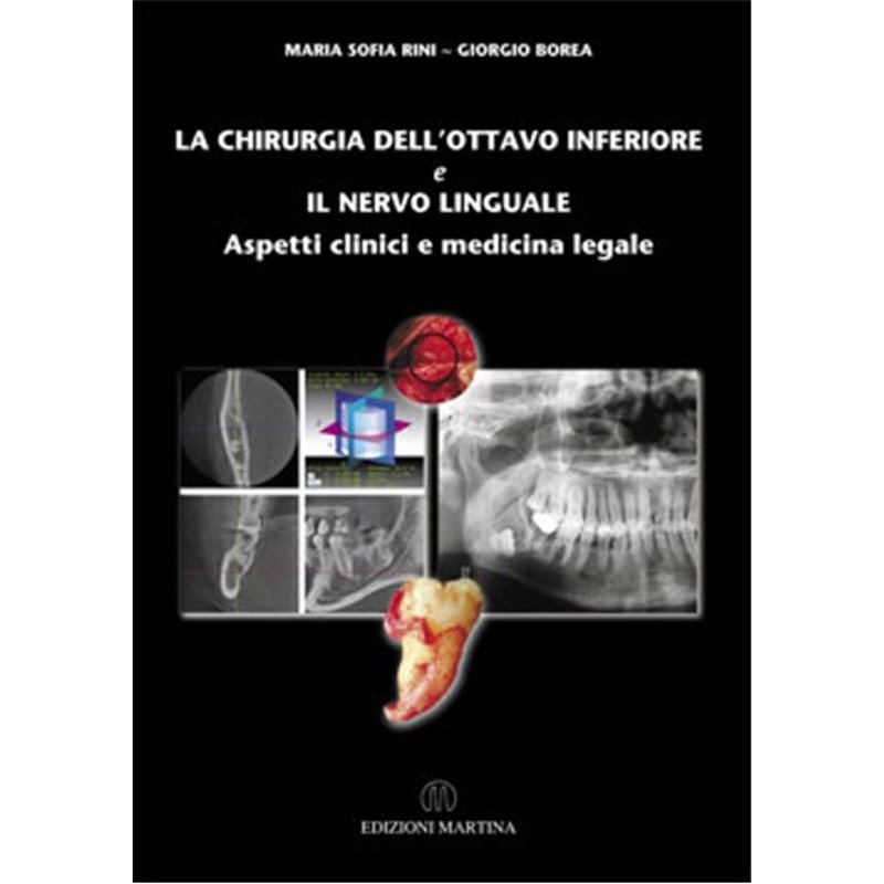 LA CHIRURGIA DELL’OTTAVO INFERIORE e IL NERVO LINGUALE - Aspetti clinici e medicina legale