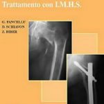 FRATTURE FEMORE PROSSIMALE: trattamento con I.M.H.S.