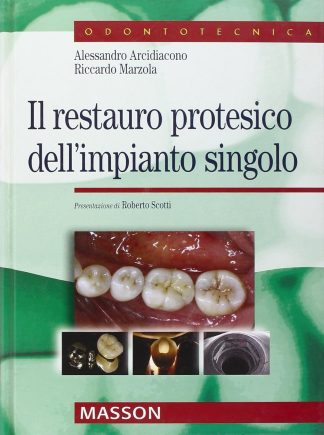 Il restauro protesico dell'impianto singolo