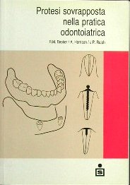 Protesi sovrapposta nella pratica odontoiatrica