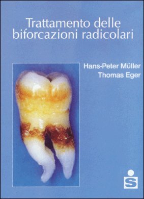 Trattamento delle biforcazioni radicolari