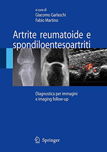 Artrite reumatoide e spondiloentesoartriti