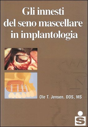 Gli innesti del seno mascellare in implantologia - immagine 2