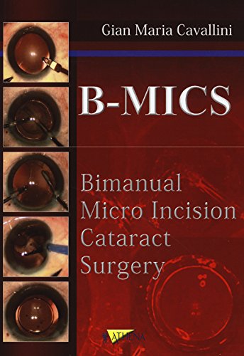 B-MICS Bimanual micro incision cataract surgery - immagine 3
