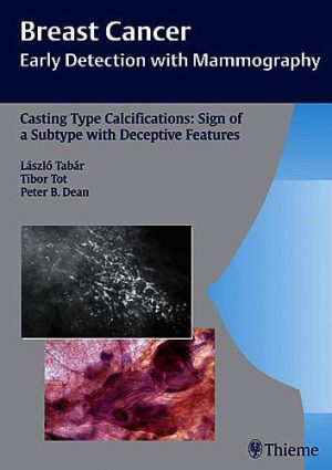 Casting Type Calcification: Sign of a Subtype with Deceptive Features