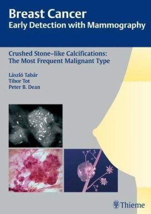 Crushed Stone-like Calcification: The most frequent Malignant type