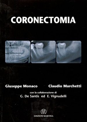 Coronectomia
